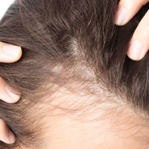 Hair Fall Treatment Hyderabad