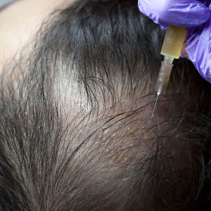 Hair Regrowth Treatment in Hyderabad