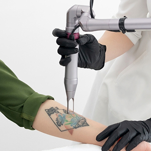 Tattoo Removal in Hyderabad